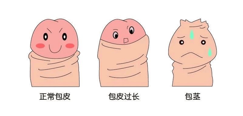包皮过长